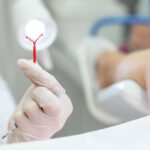 O que devo saber antes de colocar o DIU (Dispositivo intrauterino)